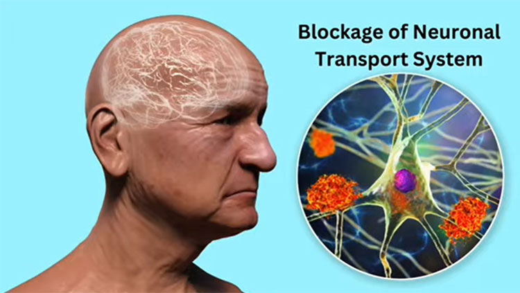 Side profile of man's face with blockage of neuronal transport system